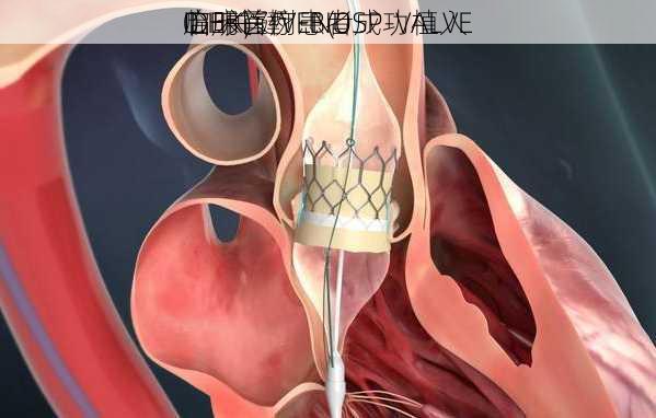 启明医疗-B(0
0.HK)：VENUSP-VALVE
IDE关键
临床首例患者成功植入